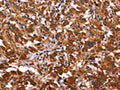 The image on the left is immunohistochemistry of paraffin-embedded Human thyroid cancer tissue using CSB-PA131138(ARL4A Antibody) at dilution 1/50, on the right is treated with fusion protein. (Original magnification: ×200)