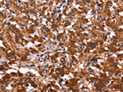 The image on the left is immunohistochemistry of paraffin-embedded Human thyroid cancer tissue using CSB-PA131138(ARL4A Antibody) at dilution 1/50, on the right is treated with fusion protein. (Original magnification: ×200)