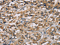 The image on the left is immunohistochemistry of paraffin-embedded Human thyroid cancer tissue using CSB-PA131153(CGA Antibody) at dilution 1/65, on the right is treated with fusion protein. (Original magnification: ×200)