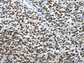 The image on the left is immunohistochemistry of paraffin-embedded Human ovarian cancer tissue using CSB-PA131190(ARL2 Antibody) at dilution 1/15, on the right is treated with fusion protein. (Original magnification: ×200)