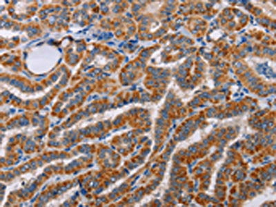 The image on the left is immunohistochemistry of paraffin-embedded Human brain tissue using CSB-PA131441(ALG9 Antibody) at dilution 1/60, on the right is treated with fusion protein. (Original magnification: ×200)