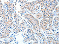 The image on the left is immunohistochemistry of paraffin-embedded Human lung cancer tissue using CSB-PA131728(ADAMTSL1 Antibody) at dilution 1/25, on the right is treated with fusion protein. (Original magnification: ×200)