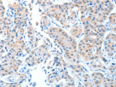 The image on the left is immunohistochemistry of paraffin-embedded Human lung cancer tissue using CSB-PA131728(ADAMTSL1 Antibody) at dilution 1/25, on the right is treated with fusion protein. (Original magnification: ×200)