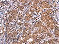 The image on the left is immunohistochemistry of paraffin-embedded Human gastic cancer tissue using CSB-PA132302(GCG Antibody) at dilution 1/40, on the right is treated with synthetic peptide. (Original magnification: ×200)