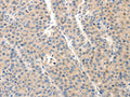 The image on the left is immunohistochemistry of paraffin-embedded Human liver cancer tissue using CSB-PA132606(SLC20A1 Antibody) at dilution 1/40, on the right is treated with synthetic peptide. (Original magnification: ×200)