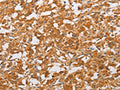 The image on the left is immunohistochemistry of paraffin-embedded Human thyroid cancer tissue using CSB-PA133010(OLR1 Antibody) at dilution 1/50, on the right is treated with fusion protein. (Original magnification: ×200)
