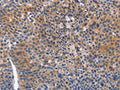 The image on the left is immunohistochemistry of paraffin-embedded Human liver cancer tissue using CSB-PA133439(ARRB1 Antibody) at dilution 1/50, on the right is treated with fusion protein. (Original magnification: ×200)