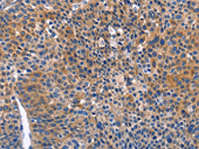 The image on the left is immunohistochemistry of paraffin-embedded Human liver cancer tissue using CSB-PA133439(ARRB1 Antibody) at dilution 1/50, on the right is treated with fusion protein. (Original magnification: ×200)