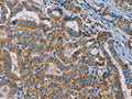 The image is immunohistochemistry of paraffin-embedded Human thyroid cancer tissue using CSB-PA133615(TAB3 Antibody) at dilution 1/25. (Original magnification: ×200)
