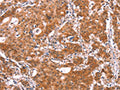 The image on the left is immunohistochemistry of paraffin-embedded Human gastic cancer tissue using CSB-PA134376(BCAR1 Antibody) at dilution 1/15, on the right is treated with synthetic peptide. (Original magnification: ×200)