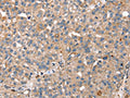 The image on the left is immunohistochemistry of paraffin-embedded Human breast cancer tissue using CSB-PA134767(RNF11 Antibody) at dilution 1/40, on the right is treated with fusion protein. (Original magnification: ×200)