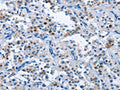 The image on the left is immunohistochemistry of paraffin-embedded Human thyroid cancer tissue using CSB-PA135119(MCM7 Antibody) at dilution 1/40, on the right is treated with fusion protein. (Original magnification: ×200)