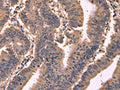 The image on the left is immunohistochemistry of paraffin-embedded Human colon cancer tissue using CSB-PA135172(GCG Antibody) at dilution 1/20, on the right is treated with synthetic peptide. (Original magnification: ×200)