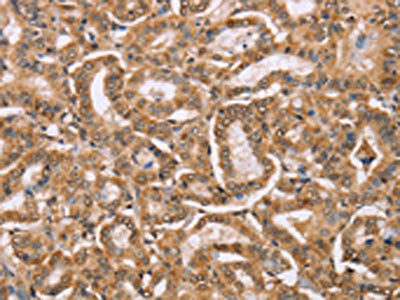 The image on the left is immunohistochemistry of paraffin-embedded Human thyroid cancer tissue using CSB-PA135204(BGLAP Antibody) at dilution 1/40, on the right is treated with synthetic peptide. (Original magnification: ×200)
