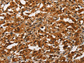 The image on the left is immunohistochemistry of paraffin-embedded Human thyroid cancer tissue using CSB-PA135409(ANAPC4 Antibody) at dilution 1/50, on the right is treated with synthetic peptide. (Original magnification: ×200)