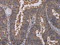The image on the left is immunohistochemistry of paraffin-embedded Human colon cancer tissue using CSB-PA135431(REG3G Antibody) at dilution 1/40, on the right is treated with fusion protein. (Original magnification: ×200)
