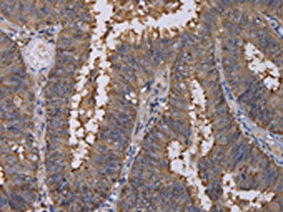 The image on the left is immunohistochemistry of paraffin-embedded Human colon cancer tissue using CSB-PA135431(REG3G Antibody) at dilution 1/40, on the right is treated with fusion protein. (Original magnification: ×200)