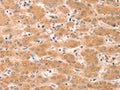 The image on the left is immunohistochemistry of paraffin-embedded Human liver cancer tissue using CSB-PA135485(GNA11 Antibody) at dilution 1/40, on the right is treated with fusion protein. (Original magnification: ×200)