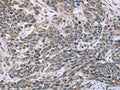 The image on the left is immunohistochemistry of paraffin-embedded Human cervical cancer tissue using CSB-PA135769(ESR2 Antibody) at dilution 1/30, on the right is treated with fusion protein. (Original magnification: ×200)