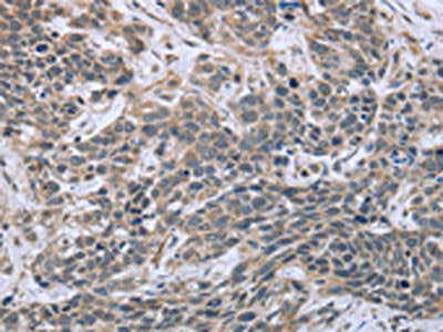 The image on the left is immunohistochemistry of paraffin-embedded Human cervical cancer tissue using CSB-PA135769(ESR2 Antibody) at dilution 1/30, on the right is treated with fusion protein. (Original magnification: ×200)