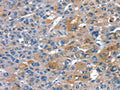The image on the left is immunohistochemistry of paraffin-embedded Human liver cancer tissue using CSB-PA135946(RNF7 Antibody) at dilution 1/20, on the right is treated with fusion protein. (Original magnification: ×200)