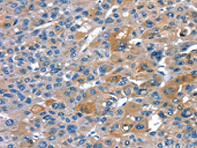 The image on the left is immunohistochemistry of paraffin-embedded Human liver cancer tissue using CSB-PA135946(RNF7 Antibody) at dilution 1/20, on the right is treated with fusion protein. (Original magnification: ×200)