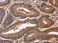 The image on the left is immunohistochemistry of paraffin-embedded Human colon cancer tissue using CSB-PA136079(CDC37L1 Antibody) at dilution 1/50, on the right is treated with fusion protein. (Original magnification: ×200)
