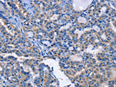 The image on the left is immunohistochemistry of paraffin-embedded Human thyroid cancer tissue using CSB-PA136137(ANXA4 Antibody) at dilution 1/20, on the right is treated with fusion protein. (Original magnification: ×200)