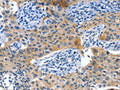 The image on the left is immunohistochemistry of paraffin-embedded Human lung cancer tissue using CSB-PA136291(ALPP Antibody) at dilution 1/60, on the right is treated with fusion protein. (Original magnification: ×200)