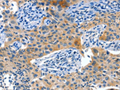 The image on the left is immunohistochemistry of paraffin-embedded Human lung cancer tissue using CSB-PA136291(ALPP Antibody) at dilution 1/60, on the right is treated with fusion protein. (Original magnification: ×200)