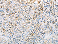 The image on the left is immunohistochemistry of paraffin-embedded Human gastic cancer tissue using CSB-PA136609(NPPC Antibody) at dilution 1/70, on the right is treated with synthetic peptide. (Original magnification: ×200)