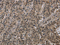 The image on the left is immunohistochemistry of paraffin-embedded Human liver cancer tissue using CSB-PA136772(HIST1H2AH Antibody) at dilution 1/40, on the right is treated with fusion protein. (Original magnification: ×200)