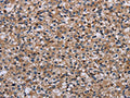 The image on the left is immunohistochemistry of paraffin-embedded Human prostate cancer tissue using CSB-PA137528(IPO4 Antibody) at dilution 1/50, on the right is treated with fusion protein. (Original magnification: ×200)