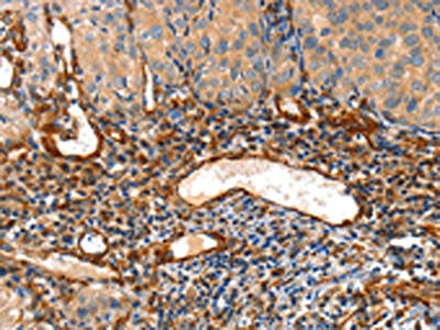 The image on the left is immunohistochemistry of paraffin-embedded Human cervical cancer tissue using CSB-PA137629(AIFM3 Antibody) at dilution 1/50, on the right is treated with fusion protein. (Original magnification: ×200)