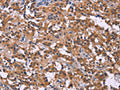 The image on the left is immunohistochemistry of paraffin-embedded Human thyroid cancer tissue using CSB-PA137893(PIP5K1B Antibody) at dilution 1/30, on the right is treated with fusion protein. (Original magnification: ×200)