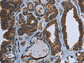 The image on the left is immunohistochemistry of paraffin-embedded Human thyroid cancer tissue using CSB-PA138466(GCK Antibody) at dilution 1/40, on the right is treated with fusion protein. (Original magnification: ×200)
