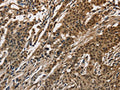 The image on the left is immunohistochemistry of paraffin-embedded Human gastic cancer tissue using CSB-PA138742(CCAR1 Antibody) at dilution 1/40, on the right is treated with fusion protein. (Original magnification: ×200)