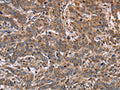 The image on the left is immunohistochemistry of paraffin-embedded Human liver cancer tissue using CSB-PA139252(FAAH2 Antibody) at dilution 1/30, on the right is treated with fusion protein. (Original magnification: ×200)