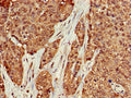 Immunohistochemistry of paraffin-embedded human ovarian cancer using CSB-PA13967A0Rb at dilution of 1:100
