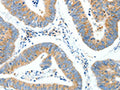 The image on the left is immunohistochemistry of paraffin-embedded Human colon cancer tissue using CSB-PA140509(NTRK1 Antibody) at dilution 1/30, on the right is treated with synthetic peptide. (Original magnification: ×200)