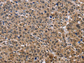 The image on the left is immunohistochemistry of paraffin-embedded Human liver cancer tissue using CSB-PA140670(KIF25 Antibody) at dilution 1/40, on the right is treated with fusion protein. (Original magnification: ×200)