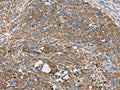 The image on the left is immunohistochemistry of paraffin-embedded Human cervical cancer tissue using CSB-PA140740(CENPO Antibody) at dilution 1/40, on the right is treated with fusion protein. (Original magnification: ×200)