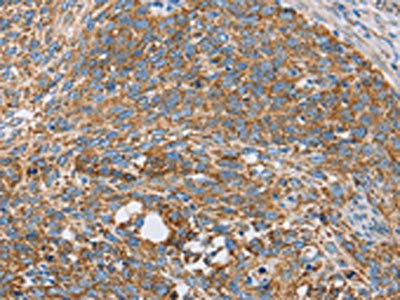 The image on the left is immunohistochemistry of paraffin-embedded Human cervical cancer tissue using CSB-PA140740(CENPO Antibody) at dilution 1/40, on the right is treated with fusion protein. (Original magnification: ×200)