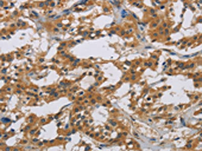 The image is immunohistochemistry of paraffin-embedded Human thyroid cancer tissue using CSB-PA140943(IL18R1 Antibody) at dilution 1/40. (Original magnification: ×200)