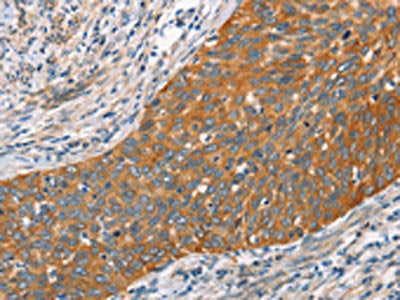 The image on the left is immunohistochemistry of paraffin-embedded Human cervical cancer tissue using CSB-PA141533(HSPB8 Antibody) at dilution 1/45, on the right is treated with fusion protein. (Original magnification: ×200)