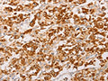 The image on the left is immunohistochemistry of paraffin-embedded Human thyroid cancer tissue using CSB-PA141591(AK2 Antibody) at dilution 1/30, on the right is treated with fusion protein. (Original magnification: ×200)