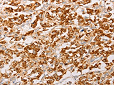 The image on the left is immunohistochemistry of paraffin-embedded Human thyroid cancer tissue using CSB-PA141591(AK2 Antibody) at dilution 1/30, on the right is treated with fusion protein. (Original magnification: ×200)