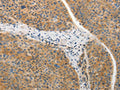 The image on the left is immunohistochemistry of paraffin-embedded Human liver cancer tissue using CSB-PA141929(ADIPOR2 Antibody) at dilution 1/20, on the right is treated with synthetic peptide. (Original magnification: ×200)
