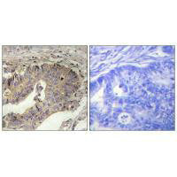 Immunohistochemical analysis of paraffin-embedded human breast carcinoma tissue, using Fibrillin-1 antibody.