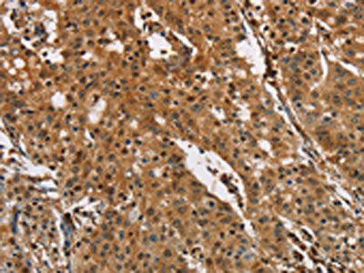 The image on the left is immunohistochemistry of paraffin-embedded Human gastic cancer tissue using CSB-PA142965(PTK6 Antibody) at dilution 1/40, on the right is treated with fusion protein. (Original magnification: ×200)